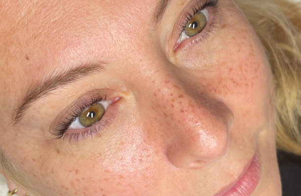 Photo formation tâches de rousseur